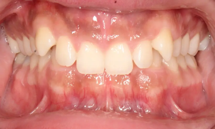 Deep Bite, front view, first image