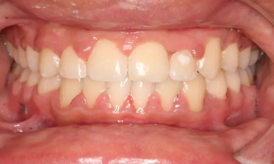 Crossbite / Impacted Canine, front view, second image