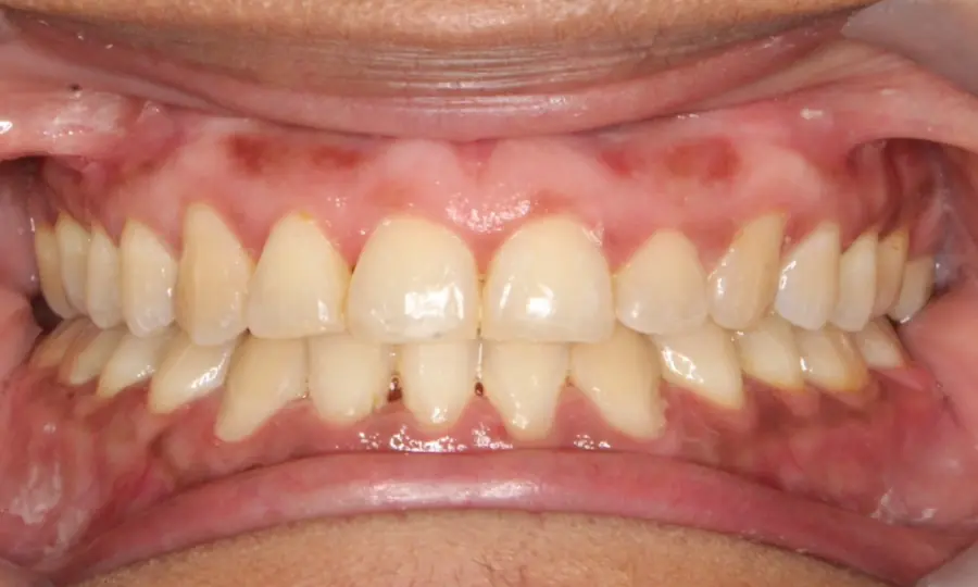 Underbite, front view, second image