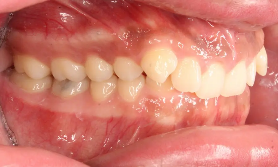 Deep Bite, left side view, first image