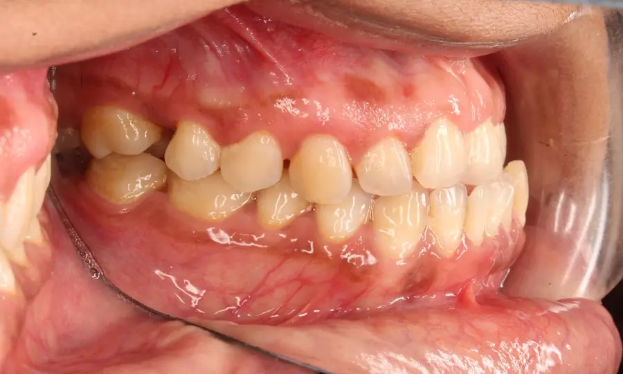 Underbite, left side view, first image
