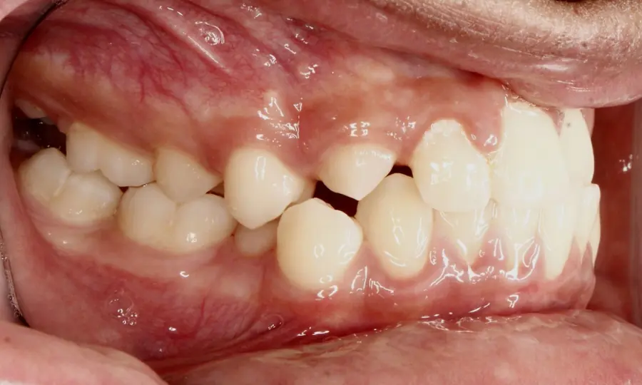 Crossbite / Impacted Canine, left side view, first image