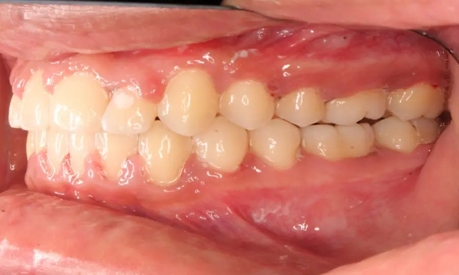 Crossbite / Impacted Canine, right side view, second image