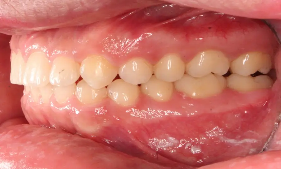 Deep Bite, right side view, second image